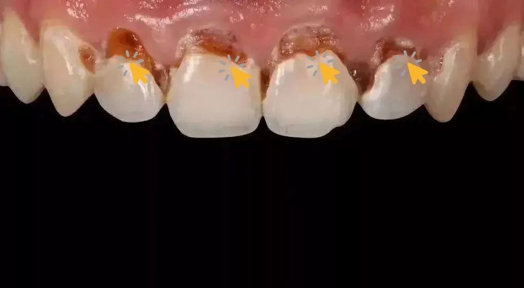 珠海牙科——什麼是牙酸蝕症?_常見問題_牙齒美白_珠海牙科種植牙-珠海箍牙-維港口腔連鎖珠海分院官網-珠海牙科種植牙-珠海箍牙-維港口腔連鎖珠海分院官網