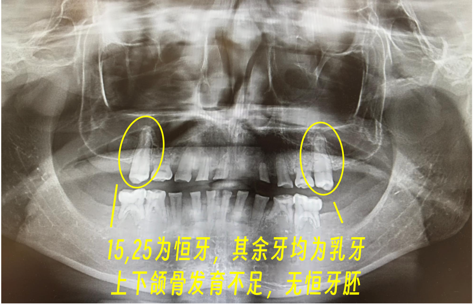 CBCT-先天缺牙.png