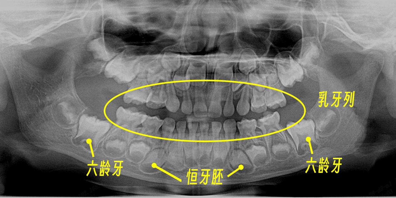 儿童换牙期间正常牙胚-ps输出.jpg